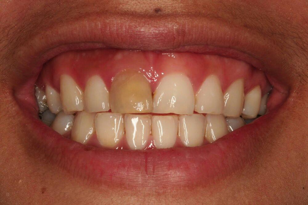 روش سفید کردن گام‌ به ‌گام دندان